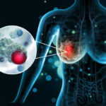 breast-cancer-diagnosis-surges-in-australia,-nz-but-death-rate-declines