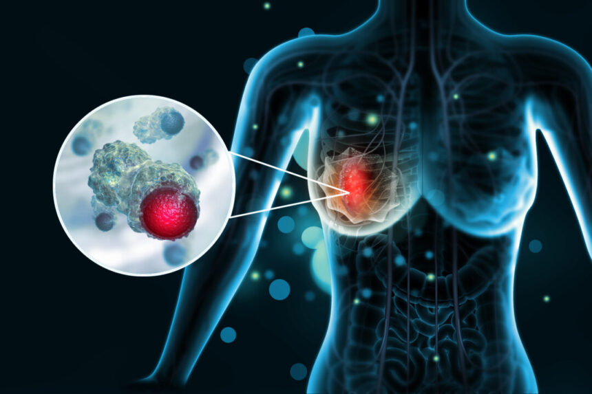 breast-cancer-diagnosis-surges-in-australia,-nz-but-death-rate-declines