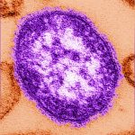 alberta-reports-new-measles-cases-and-potential-exposures,-bringing-active-total-to-14