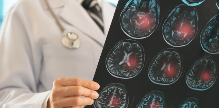 how-stem-cell-therapy-can-regenerate-brain-tissue-after-a-stroke