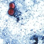 disease-caused-by-cyclospora-parasite-now-in-45-states:-cdc